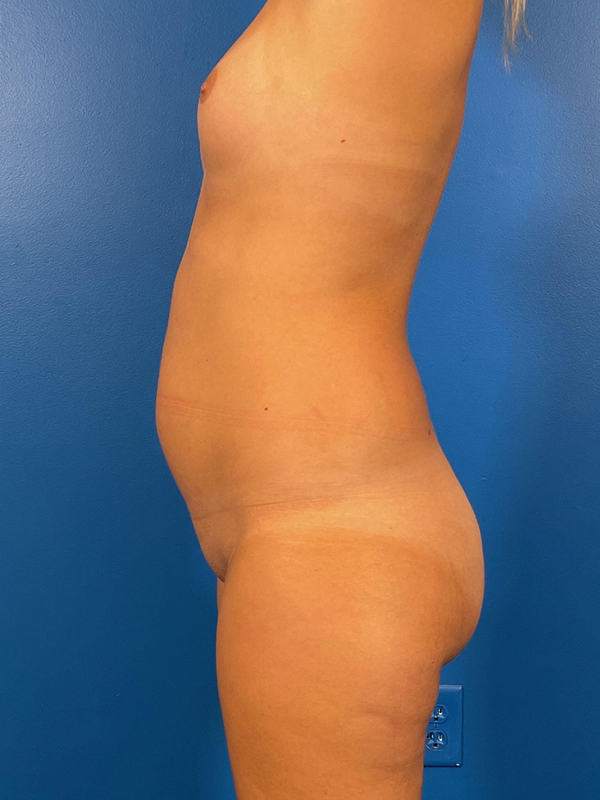 Liposuction Before and After | Plastic Surgery Associates of Valdosta