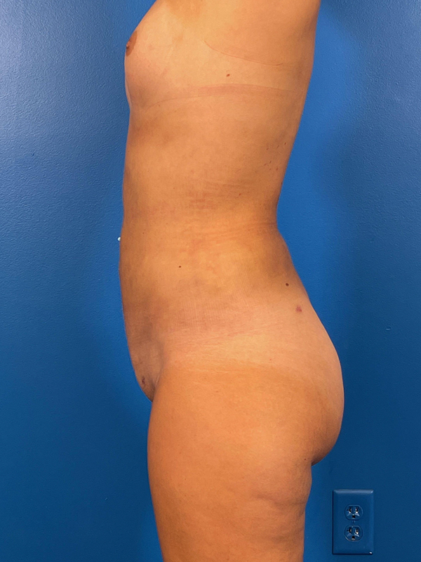 Liposuction Before and After | Plastic Surgery Associates of Valdosta