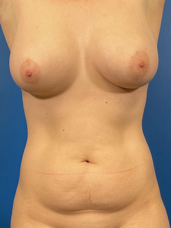 Liposuction Before and After | Plastic Surgery Associates of Valdosta