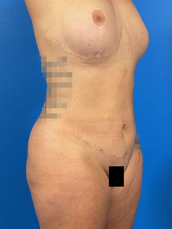 Liposuction Before and After | Plastic Surgery Associates of Valdosta