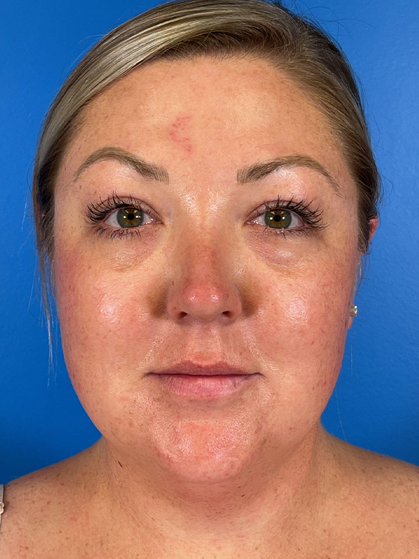 Liposuction Before and After | Plastic Surgery Associates of Valdosta