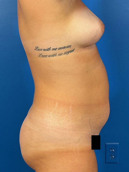Liposuction Before and After | Plastic Surgery Associates of Valdosta