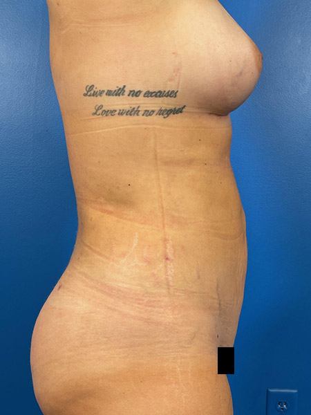 Liposuction Before and After | Plastic Surgery Associates of Valdosta