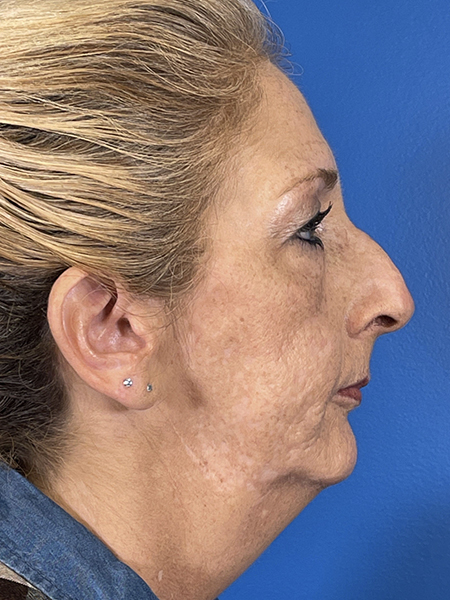 Liquid Rhinoplasty Before and After | Plastic Surgery Associates of Valdosta