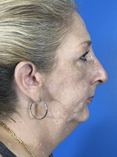 Liquid Rhinoplasty Before and After | Plastic Surgery Associates of Valdosta