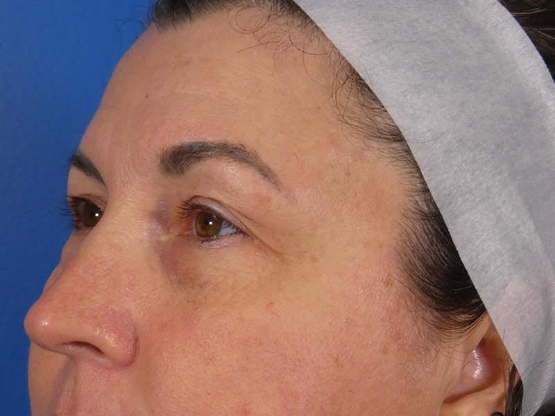Microneedling Before and After | Plastic Surgery Associates of Valdosta