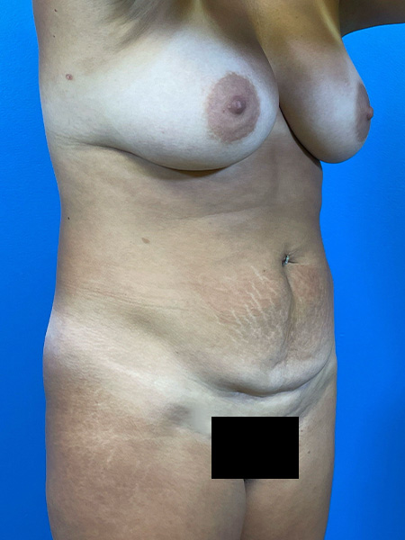 Mommy Makeover Before and After | Plastic Surgery Associates of Valdosta