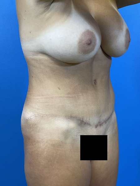 Mommy Makeover Before and After | Plastic Surgery Associates of Valdosta