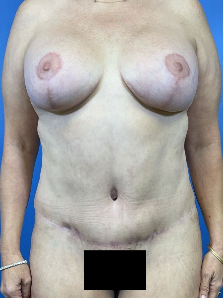 Mommy Makeover Before and After | Plastic Surgery Associates of Valdosta