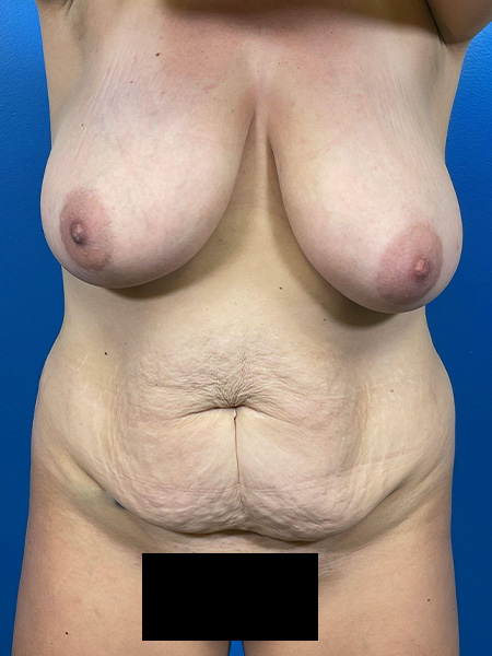 Mommy Makeover Before and After | Plastic Surgery Associates of Valdosta