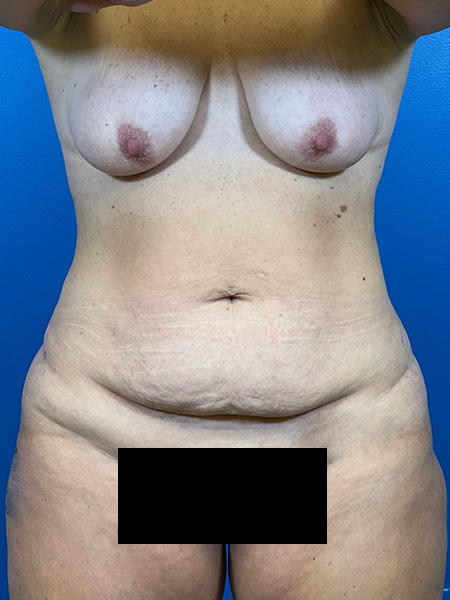 Mommy Makeover Before and After | Plastic Surgery Associates of Valdosta