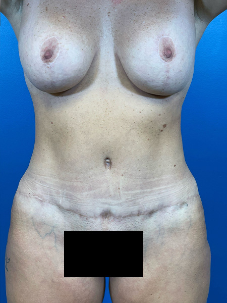 Mommy Makeover Before and After | Plastic Surgery Associates of Valdosta