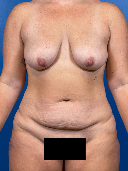 Mommy Makeover Before and After | Plastic Surgery Associates of Valdosta