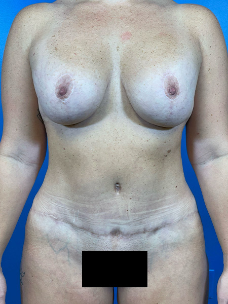 Mommy Makeover Before and After | Plastic Surgery Associates of Valdosta
