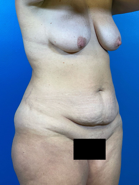 Mommy Makeover Before and After | Plastic Surgery Associates of Valdosta