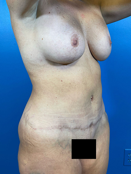 Mommy Makeover Before and After | Plastic Surgery Associates of Valdosta
