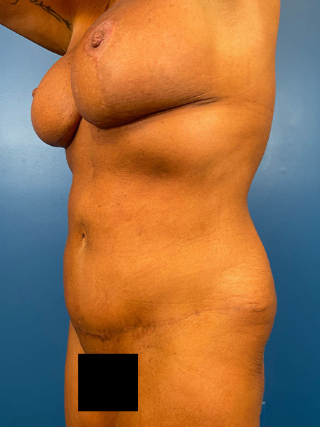 Mommy Makeover Before and After | Plastic Surgery Associates of Valdosta