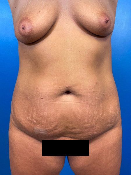 Mommy Makeover Before and After | Plastic Surgery Associates of Valdosta