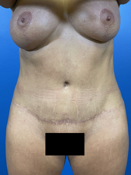 Mommy Makeover Before and After | Plastic Surgery Associates of Valdosta