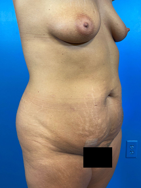 Mommy Makeover Before and After | Plastic Surgery Associates of Valdosta