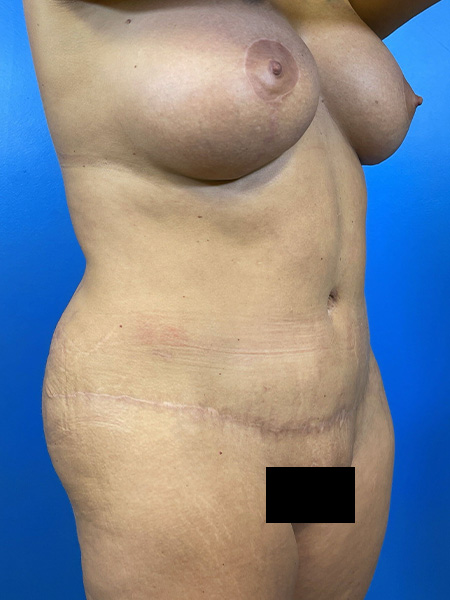 Mommy Makeover Before and After | Plastic Surgery Associates of Valdosta