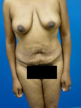 Mommy Makeover Before and After | Plastic Surgery Associates of Valdosta