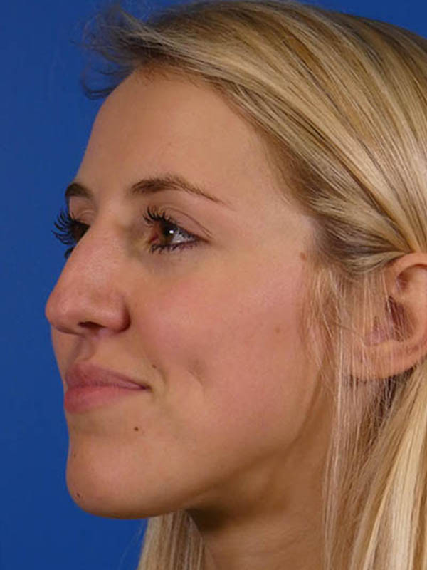 Rhinoplasty Before and After | Plastic Surgery Associates of Valdosta