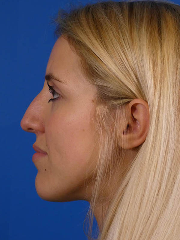 Rhinoplasty Before and After | Plastic Surgery Associates of Valdosta