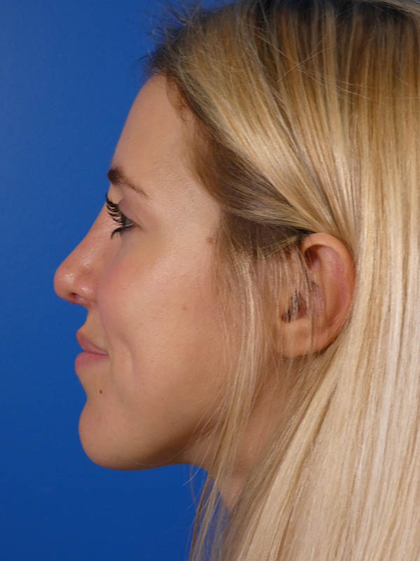 Rhinoplasty Before and After | Plastic Surgery Associates of Valdosta