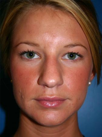 Rhinoplasty Before and After | Plastic Surgery Associates of Valdosta