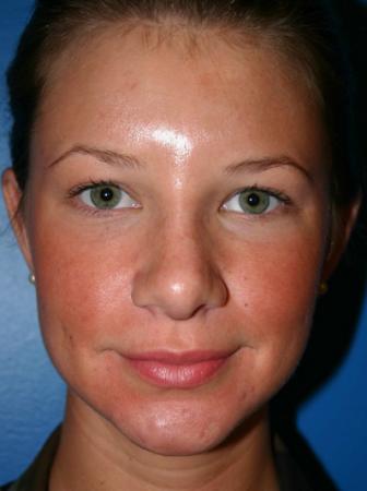 Rhinoplasty Before and After | Plastic Surgery Associates of Valdosta