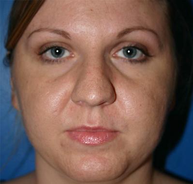 Rhinoplasty Before and After | Plastic Surgery Associates of Valdosta