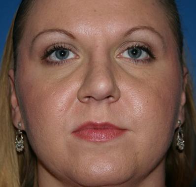 Rhinoplasty Before and After | Plastic Surgery Associates of Valdosta