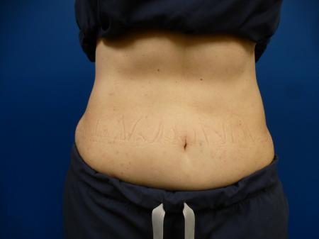 Sculpsure Before and After | Plastic Surgery Associates of Valdosta