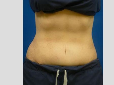 Sculpsure Before and After | Plastic Surgery Associates of Valdosta