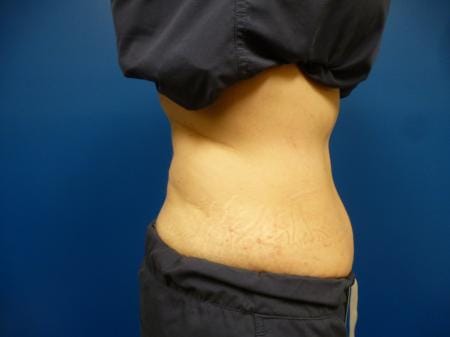 Sculpsure Before and After | Plastic Surgery Associates of Valdosta