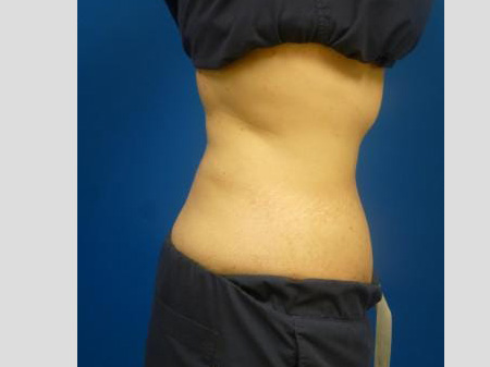 Sculpsure Before and After | Plastic Surgery Associates of Valdosta