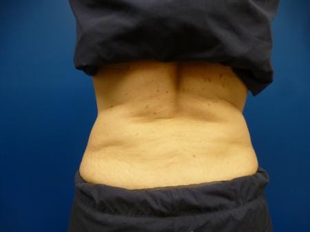 Sculpsure Before and After | Plastic Surgery Associates of Valdosta