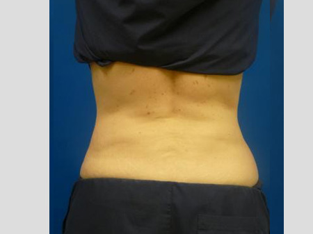 Sculpsure Before and After | Plastic Surgery Associates of Valdosta