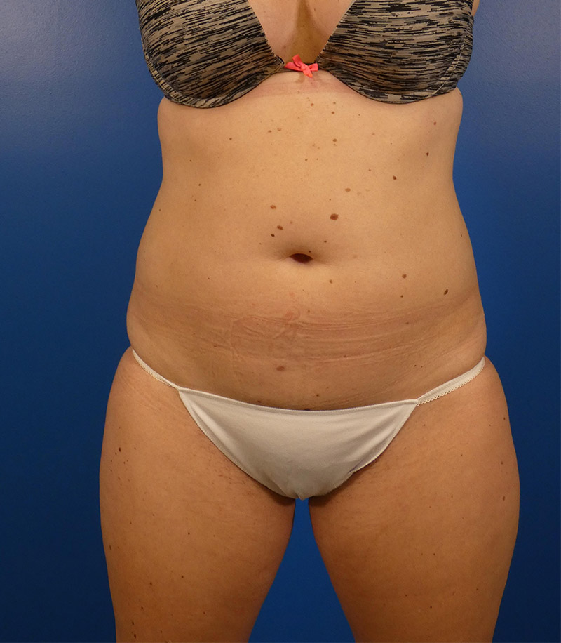 Sculpsure Before and After | Plastic Surgery Associates of Valdosta