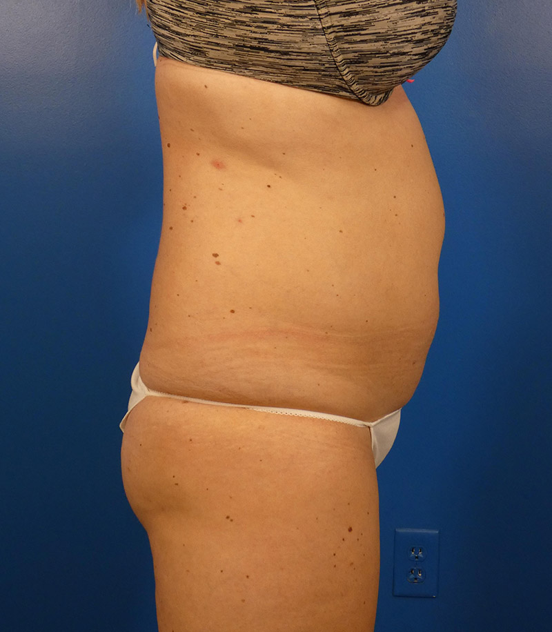 Sculpsure Before and After | Plastic Surgery Associates of Valdosta