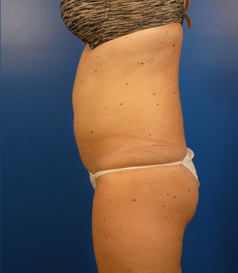 Sculpsure Before and After | Plastic Surgery Associates of Valdosta