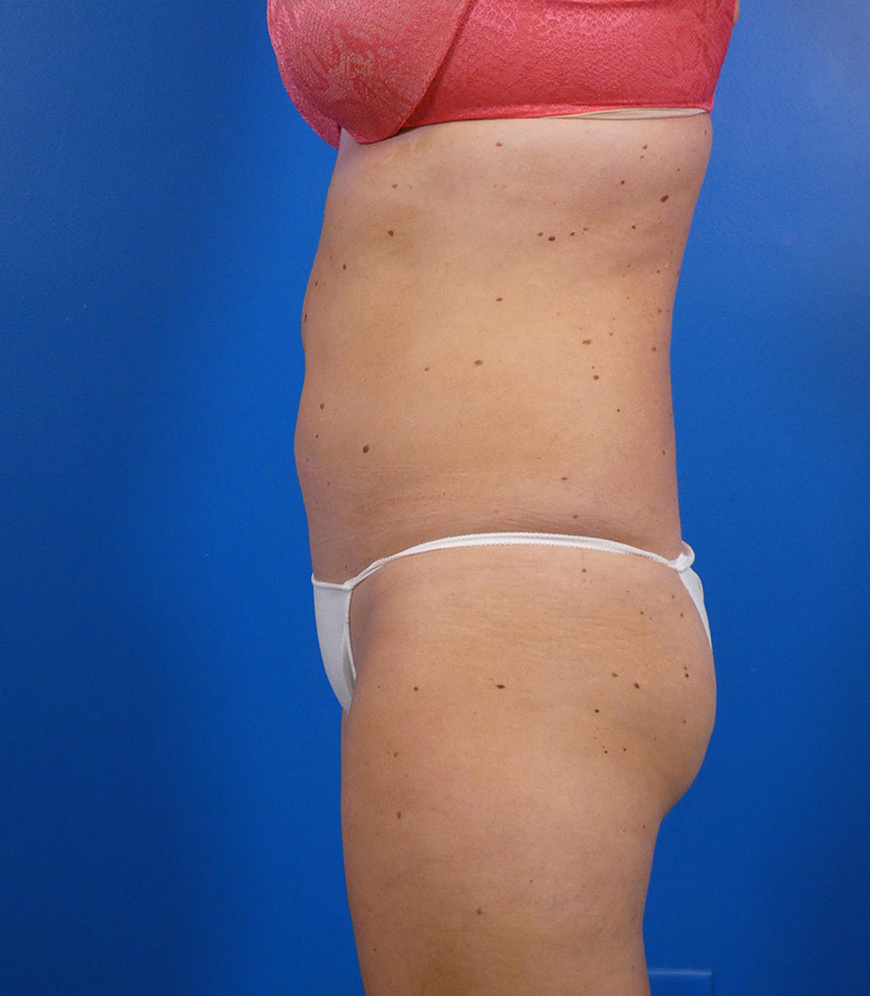 Sculpsure Before and After | Plastic Surgery Associates of Valdosta