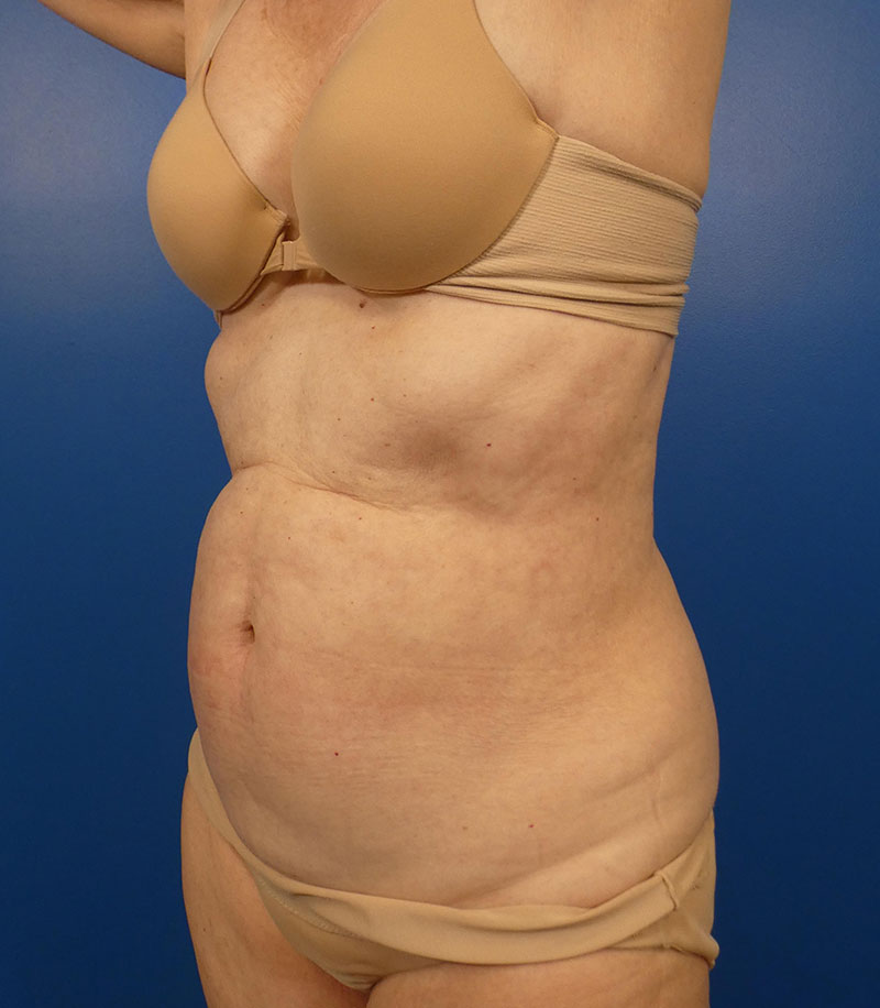 Sculpsure Before and After | Plastic Surgery Associates of Valdosta