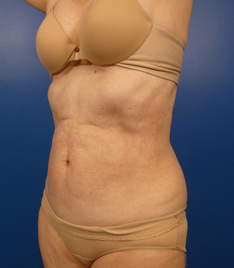 Sculpsure Before and After | Plastic Surgery Associates of Valdosta