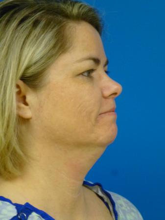 Thermitight Before and After | Plastic Surgery Associates of Valdosta