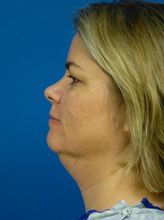 Thermitight Before and After | Plastic Surgery Associates of Valdosta