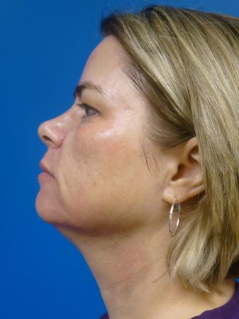 Thermitight Before and After | Plastic Surgery Associates of Valdosta