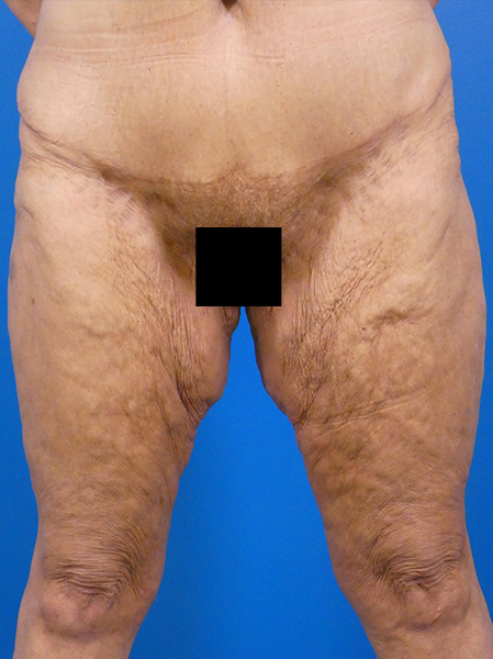 Thighplasty Before and After | Plastic Surgery Associates of Valdosta