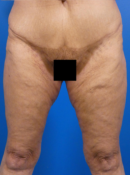 Thighplasty Before and After | Plastic Surgery Associates of Valdosta